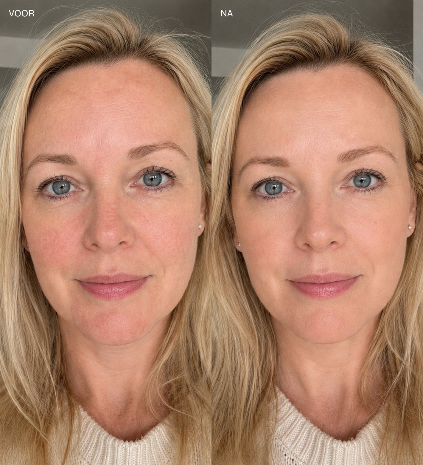 Voor en na vergelijking van een blonde vrouw met een egale huidtransformatie na het aanbrengen van Meroda foundation.